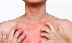Uyuz nedir, nasıl geçer? Uyuz hastalığının belirtileri nelerdir?