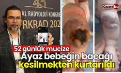 52 günlük mucize: Ayaz bebeğin bacağı kesilmekten kurtarıldı