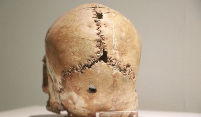 10.500 Yıl Önce  Yapılan Dünyanın İlk Beyin Ameliyatı