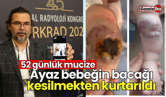 52 günlük mucize: Ayaz bebeğin bacağı kesilmekten kurtarıldı