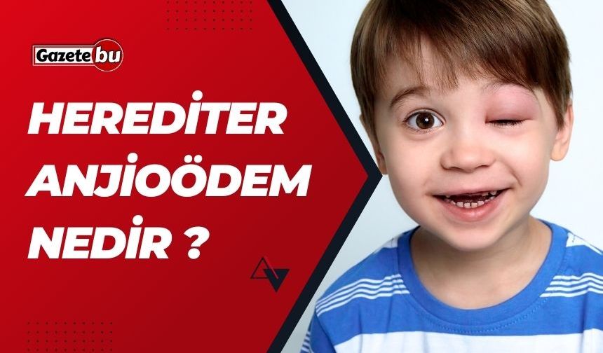 Herediter anjioödem nedir ? Ne Tetikler ? Tehlikeli mi ?