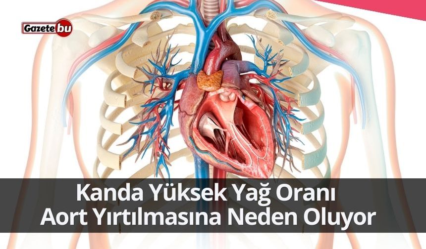 Kanda Yüksek Yağ Oranı  Aort Yırtılmasına Neden Oluyor