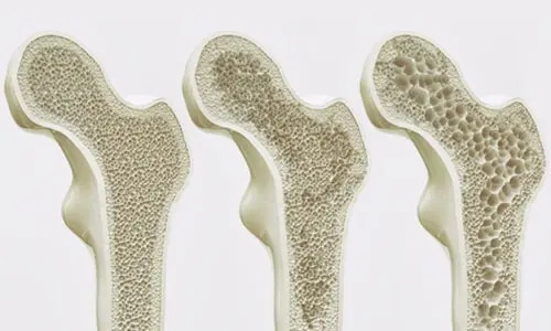 Osteoporoz Kemik Erimesi Bagli Kalca Kirigi
